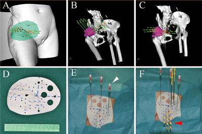 Radioactive Iodine-125 in Tumor Therapy: Advances and Future Directions